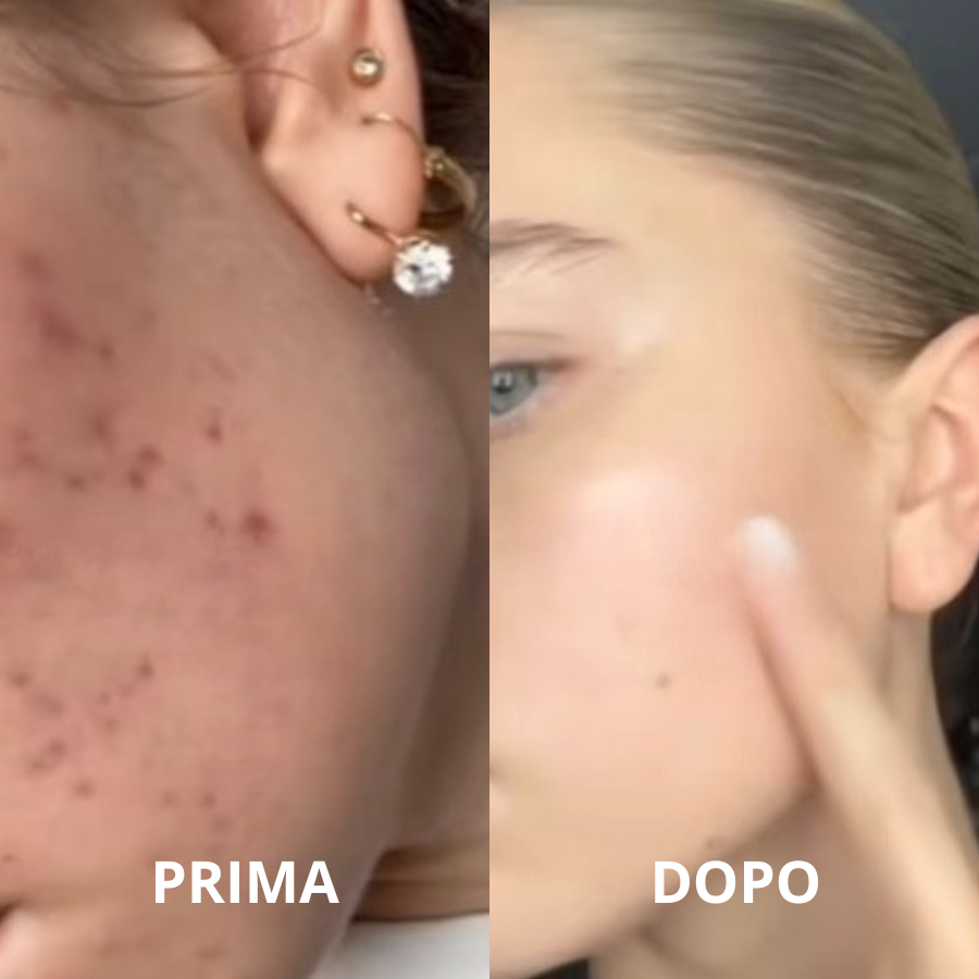 Aliviagen Elyse – Maschera LED in Silicone (Anti-Age & Acne)