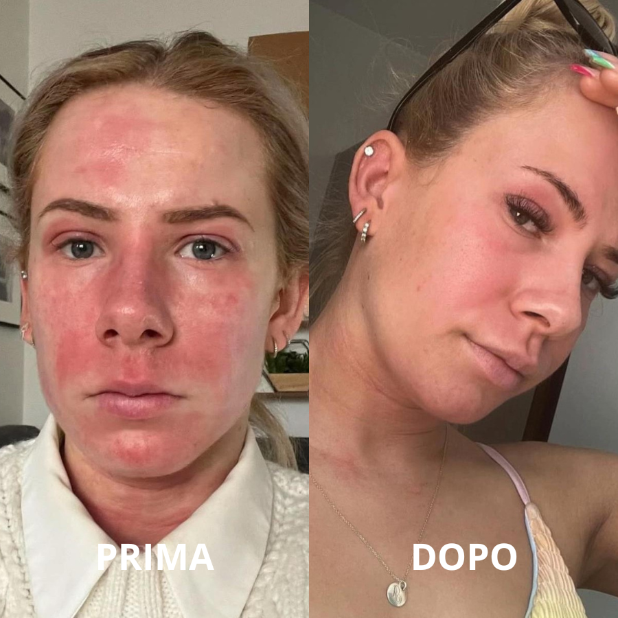 Aliviagen Elyse – Maschera LED in Silicone (Anti-Age & Acne)