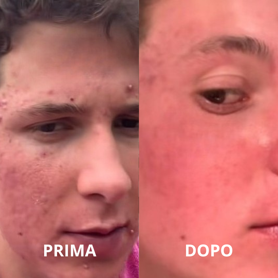 Aliviagen Elyse – Maschera LED in Silicone (Anti-Age & Acne)