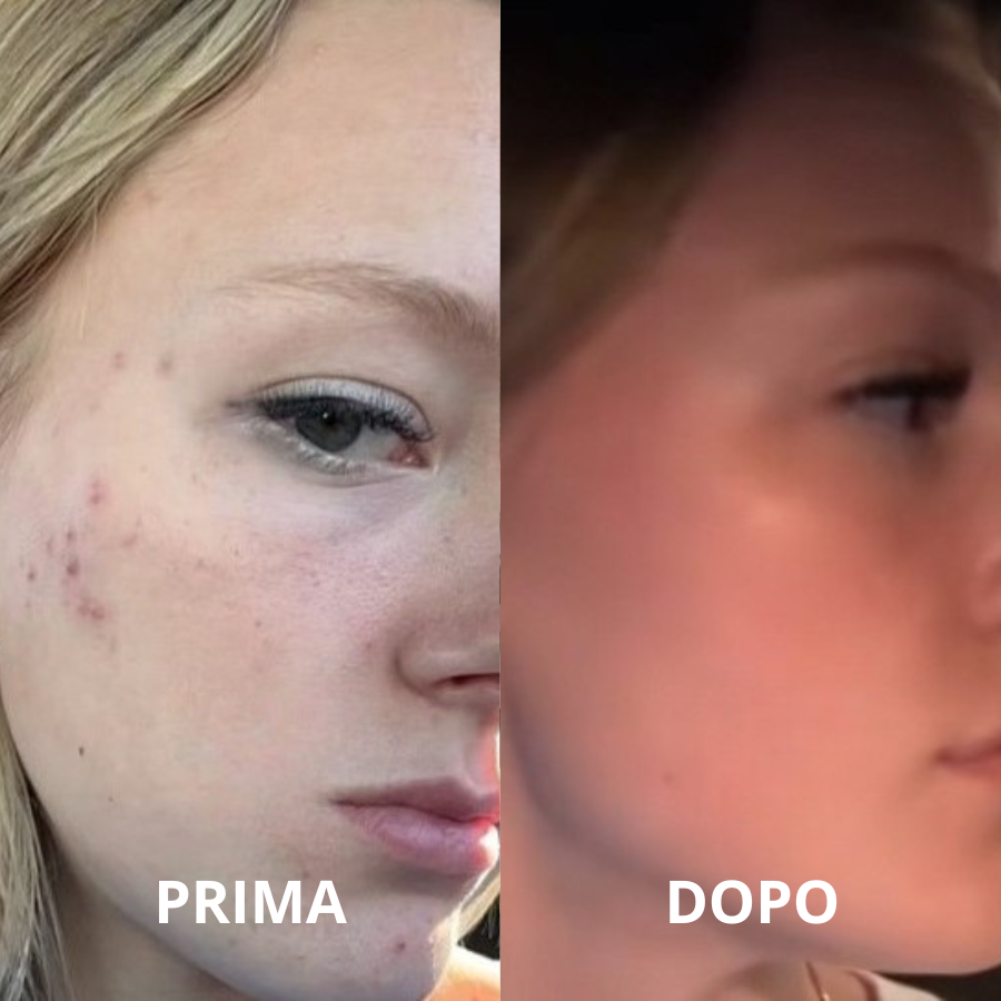 Aliviagen Elyse – Maschera LED in Silicone (Anti-Age & Acne)